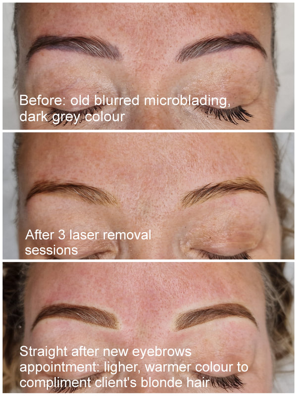eyebrow tattoo removal with laser