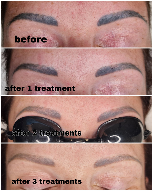 microblading removal with laser
