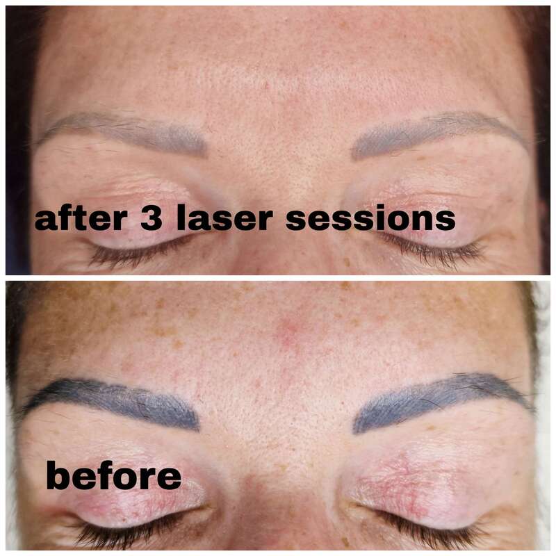 eyebrow tattoo removal cambridge