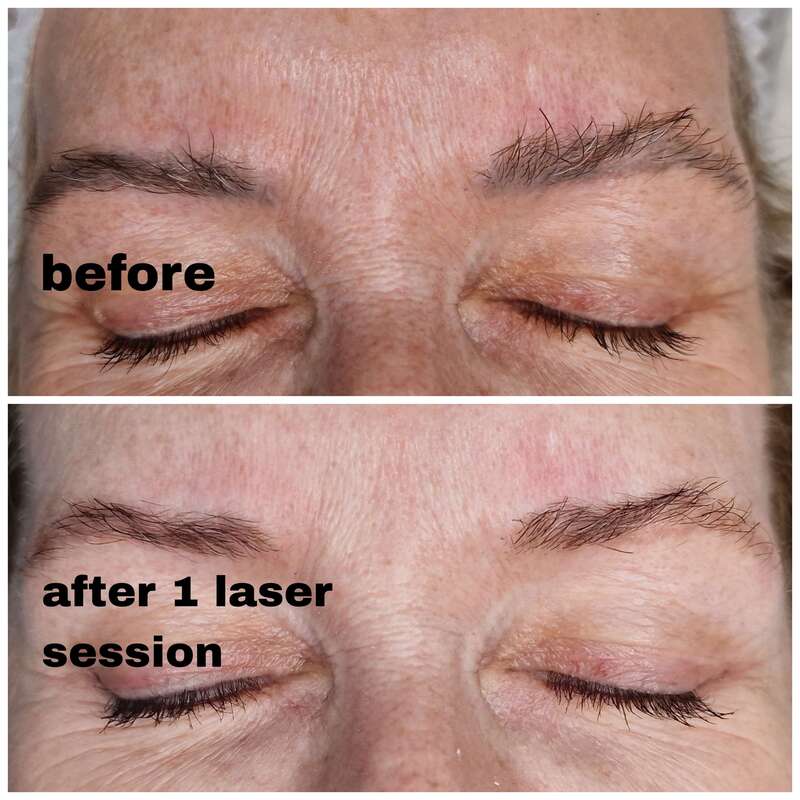 laser eyebrow tattoo removal