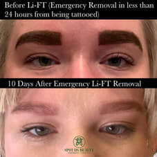 Permanent makeup removal cambridge
