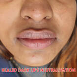 dark lips neutralisation cambridge