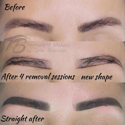 Permanent eyebrows removal