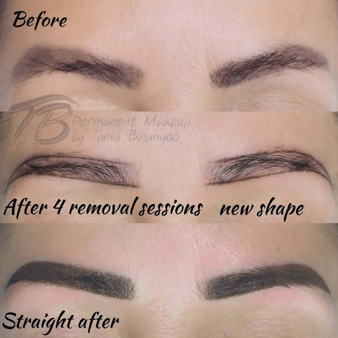 Aggregate 72+ brow tattoo removal best - in.eteachers